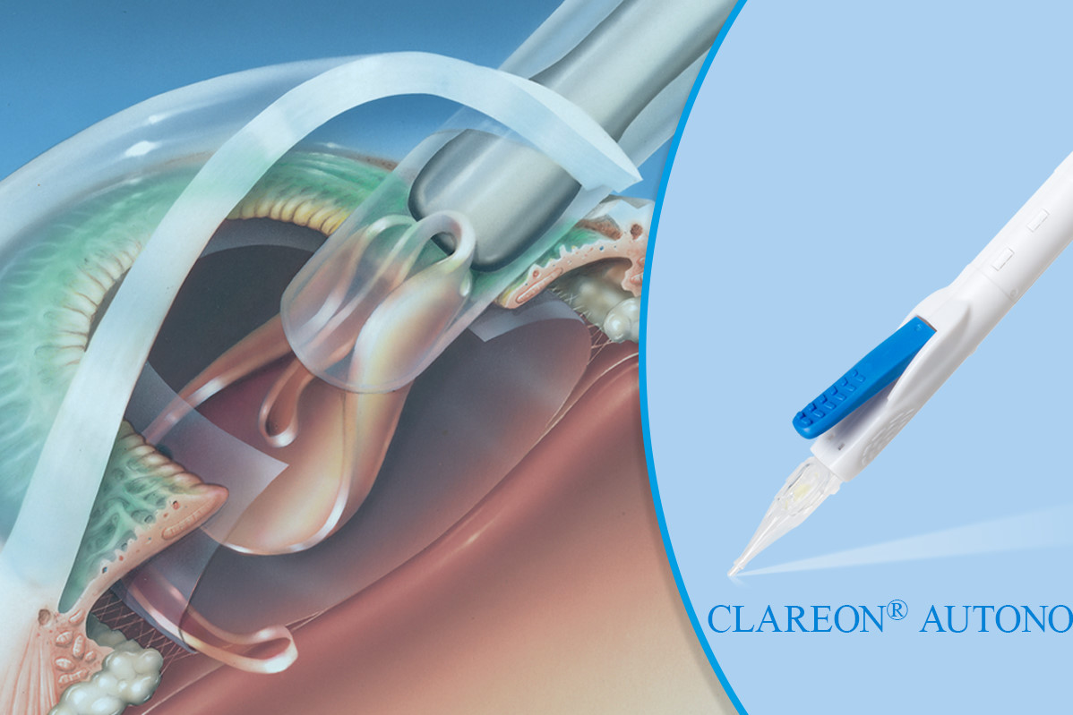 Alcon’s new IOL arrives eyeonoptics