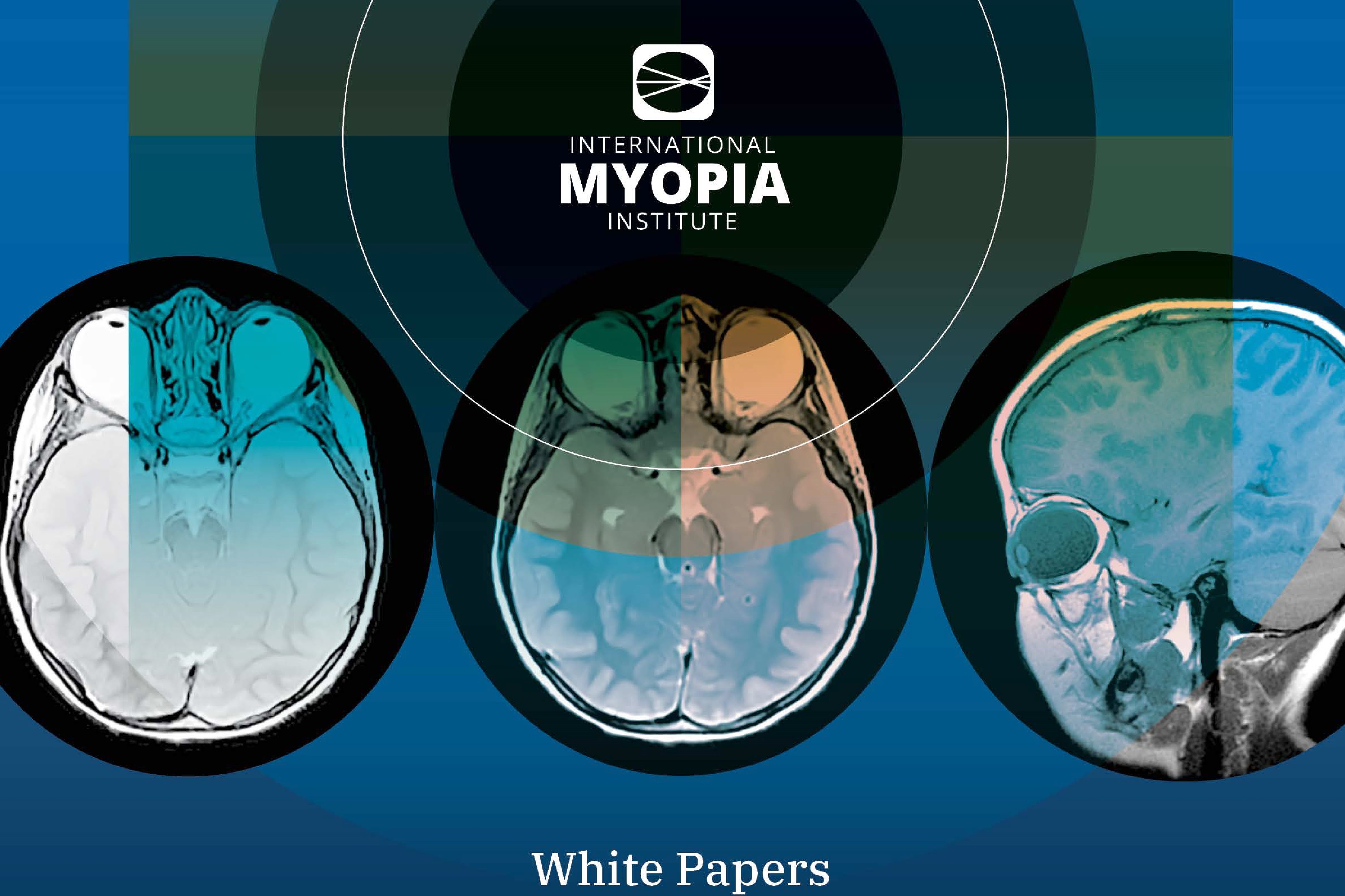 Prevalence of myopia in india 2019 image