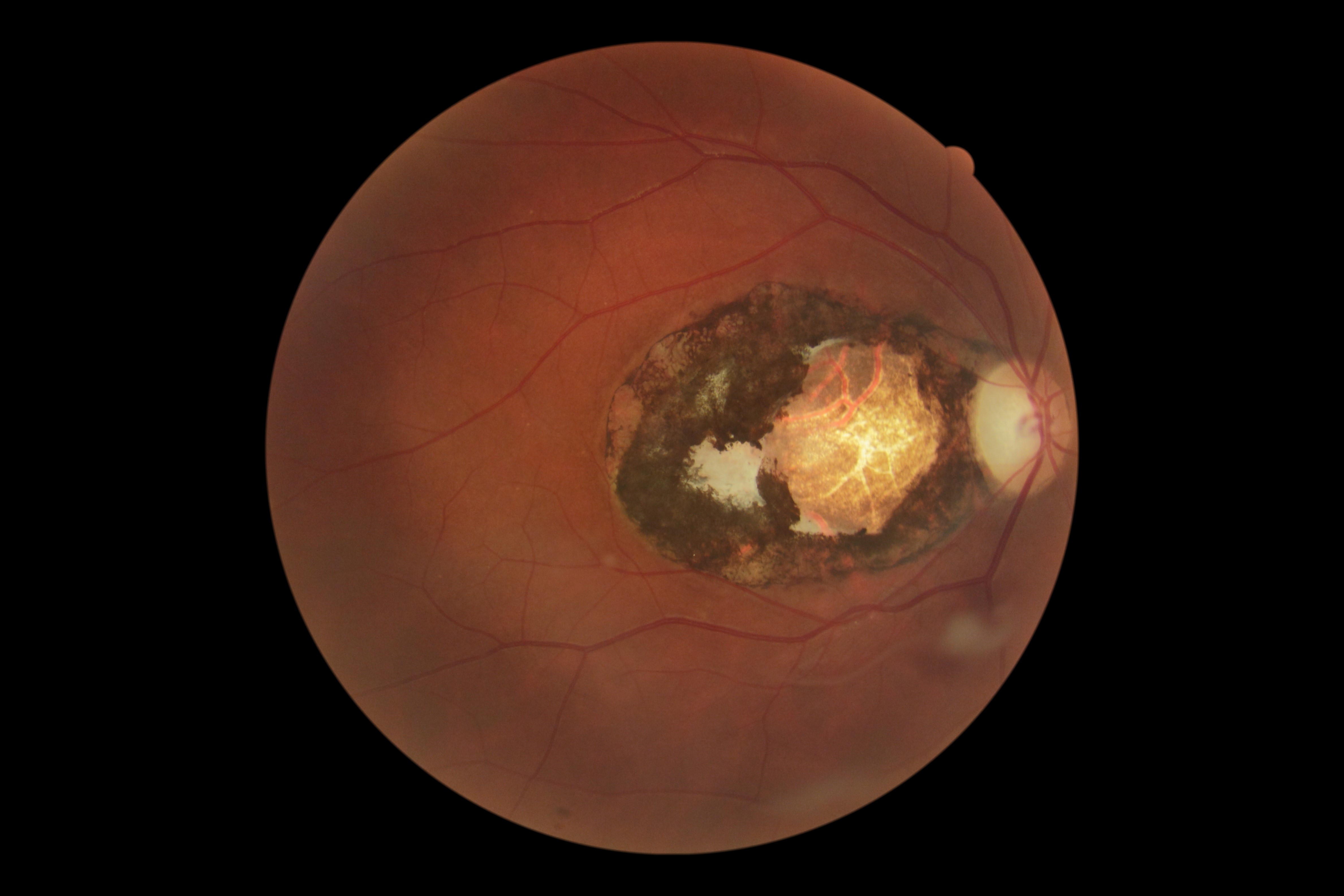 Ocular toxoplasmosis: more common than thought