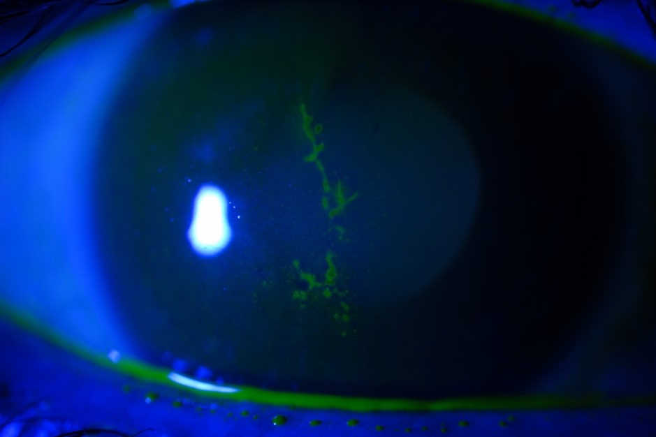 Update on herpes zoster ophthalmicus nzoptics