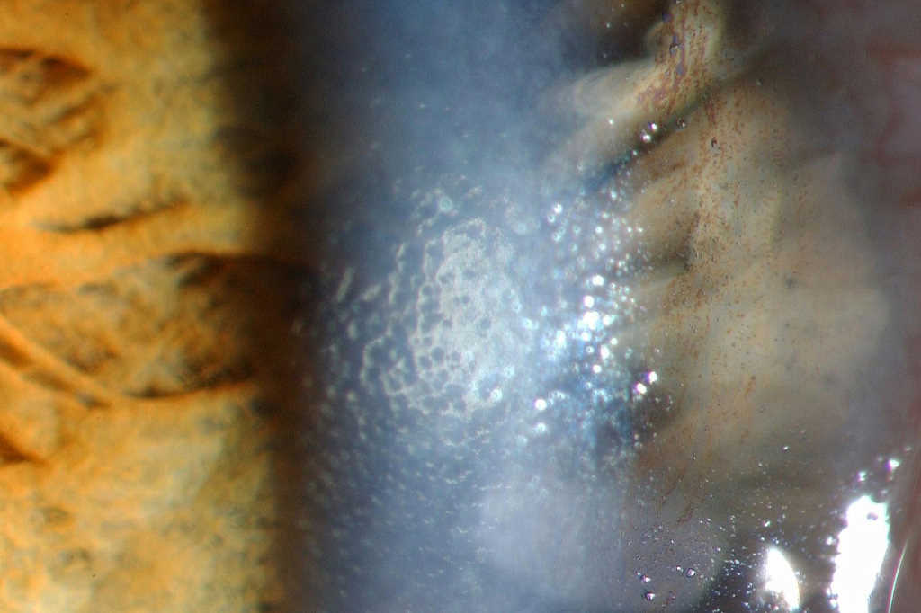 Fuchs’ endothelial corneal dystrophy beaten metal to rock nzoptics