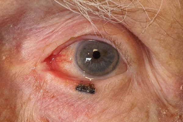 Diagnosis and management of eyelid melanoma