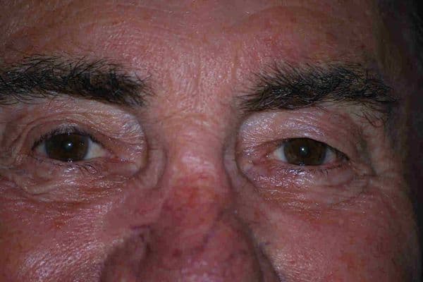 Krill vs fish oil and other eye treatments