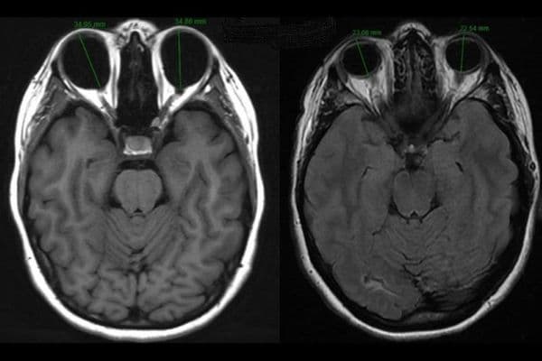 Pathological myopia
