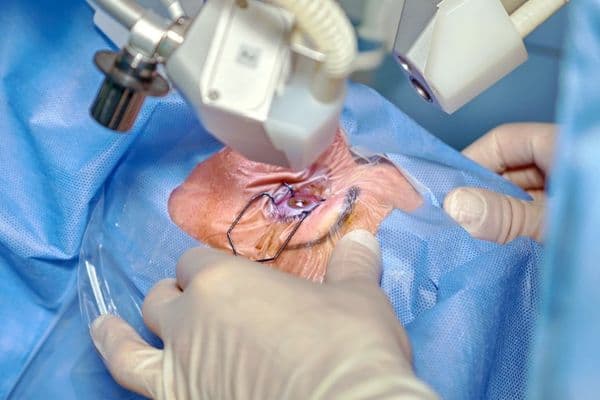 Refractive surgery evidence review