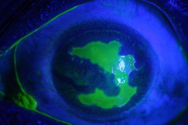 ARN  a rare but important cause of uveitis