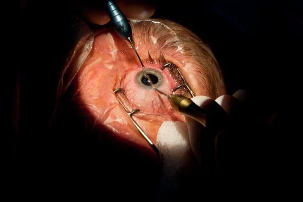 Importance of risk stratification in modern cataract surgery