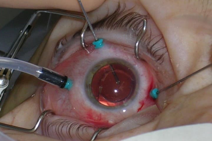 vitrectomy operation online