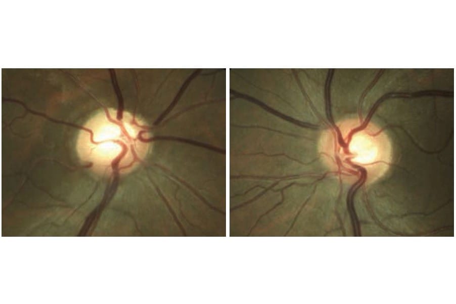 CASE STUDY: Glaucoma masqueraders