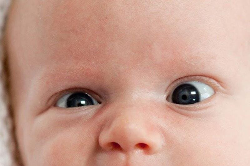 AAO backs Botox for strabismus (1)