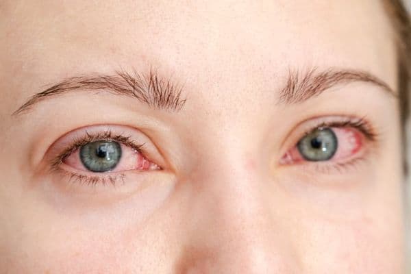 close up red irritated human eyes