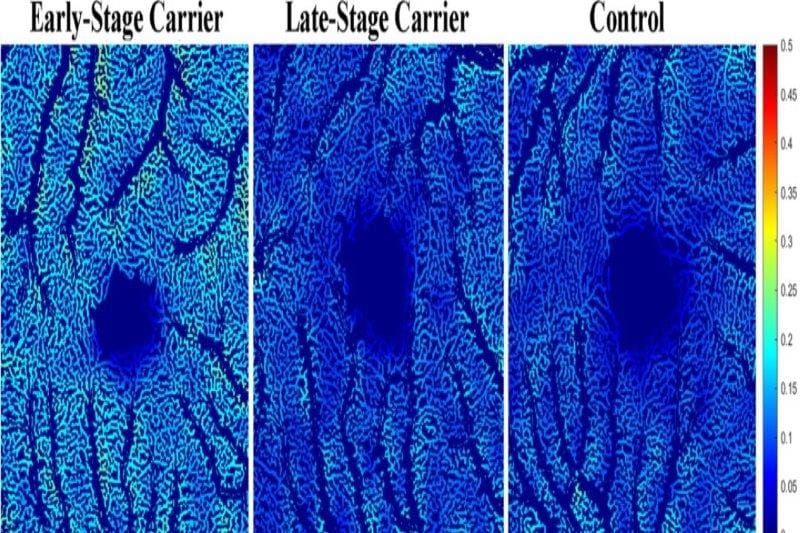 Retinal blood flow may predict Alzheimer’s