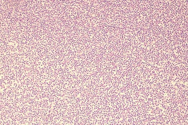 endophthalmitis case