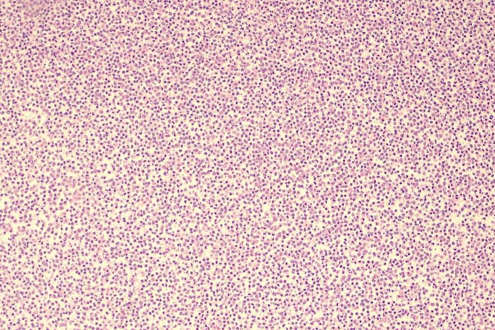 endophthalmitis case
