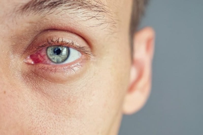 Age affects uveitis impact
