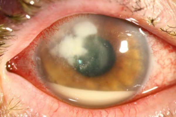 fungal keratitis online