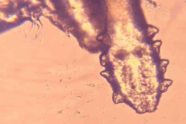 Blepharitis and Dry Eye, chicken or the egg?