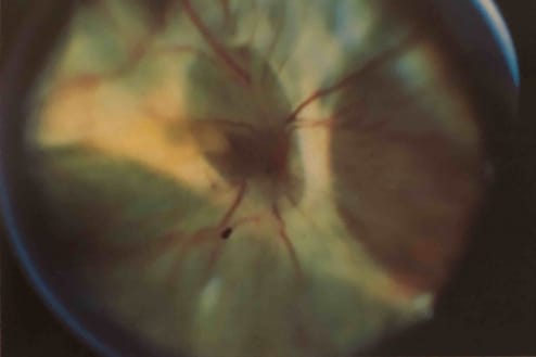 pvr proliferative vitreoretinopathy