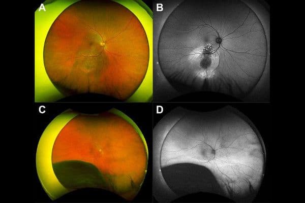 figure 2 posterior uveal melanoma online 1