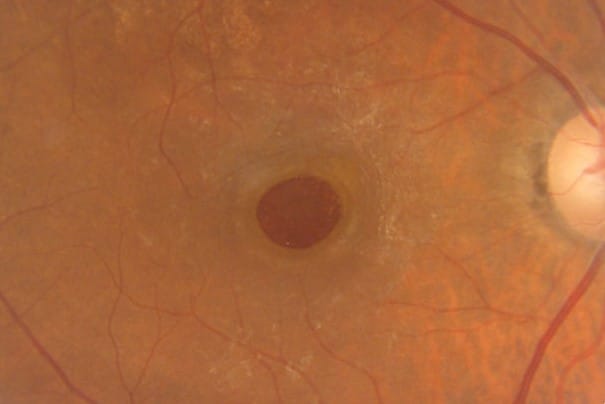 Silicone oil closes macular holes