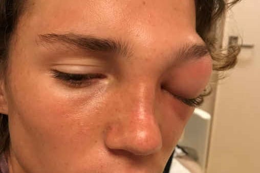Case study: orbital cellulitis