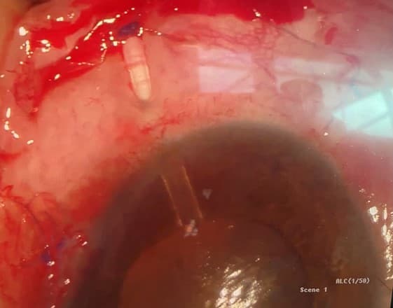 Managing glaucoma – a journey of faith and patience-fig-1.jpg