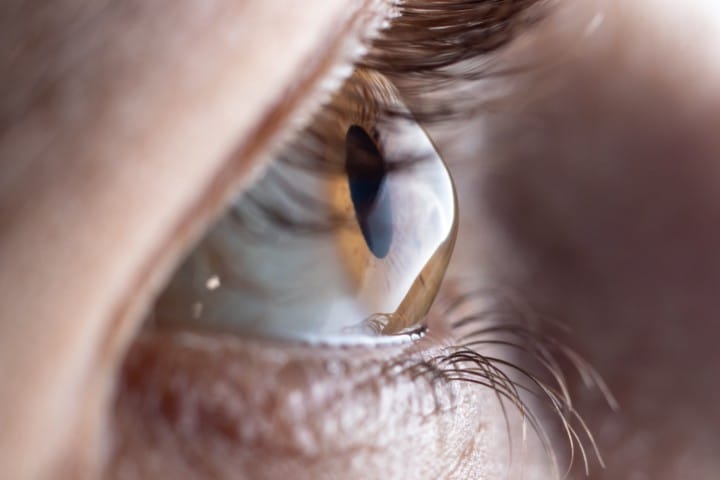 Assessing extent of keratoconus in Gisborne