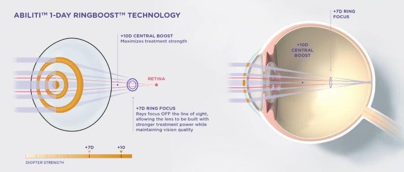 Abiliti Ringboost Technology Diagram (1)