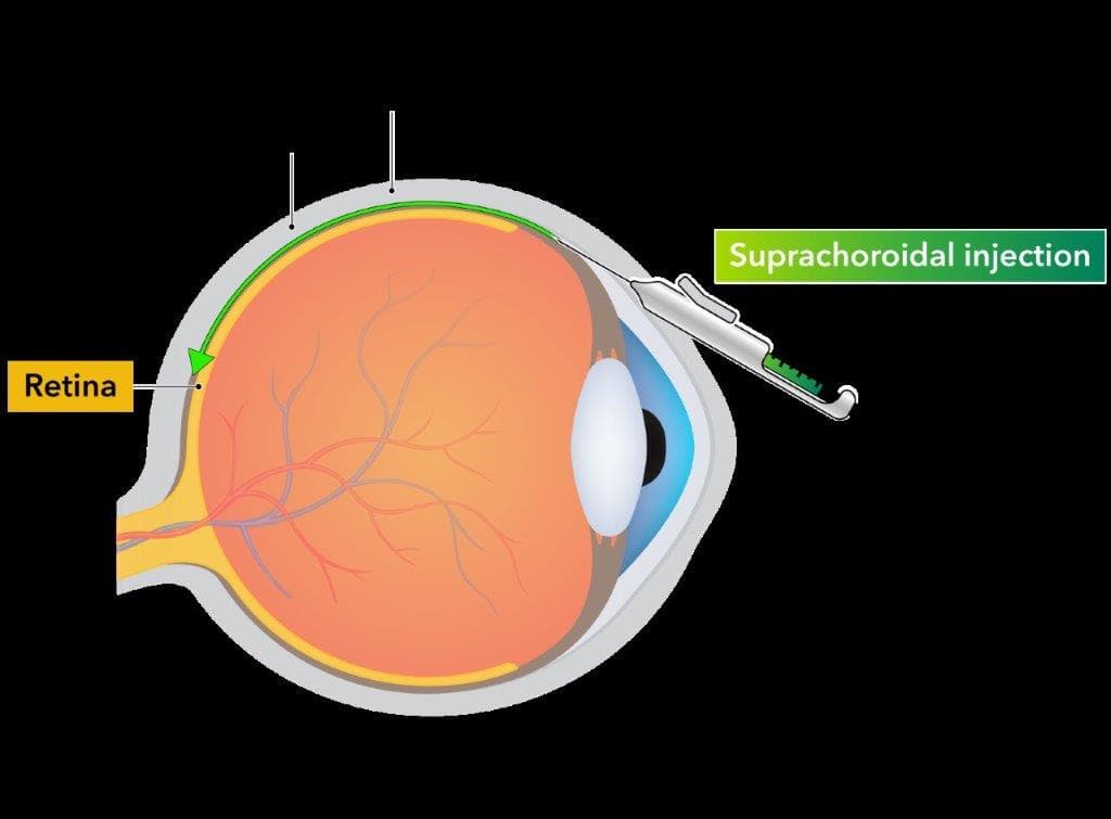 Suprachoroidal Injection Med