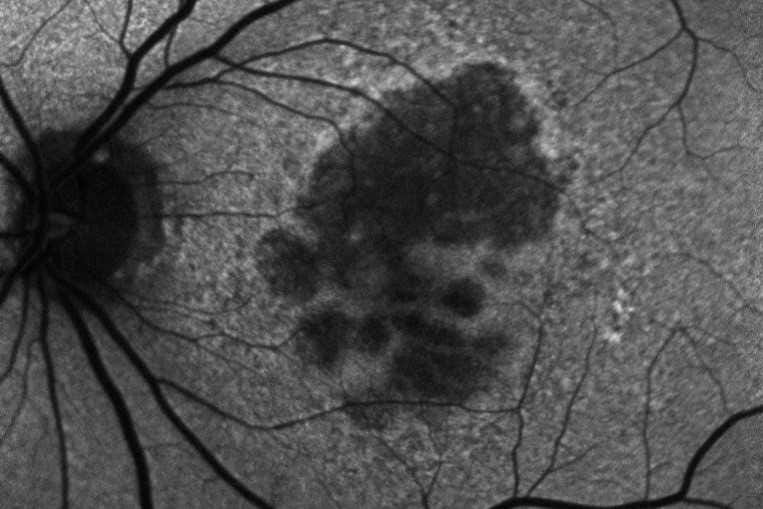 Established and emerging trends in AMD management