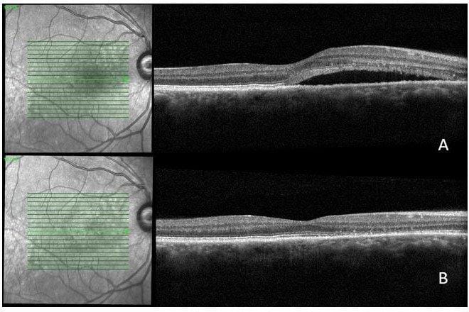 Central serous chorioretinopathy cases