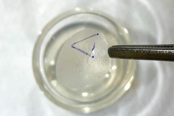 Amniotic membrane in optometry practice for dry eye patients?