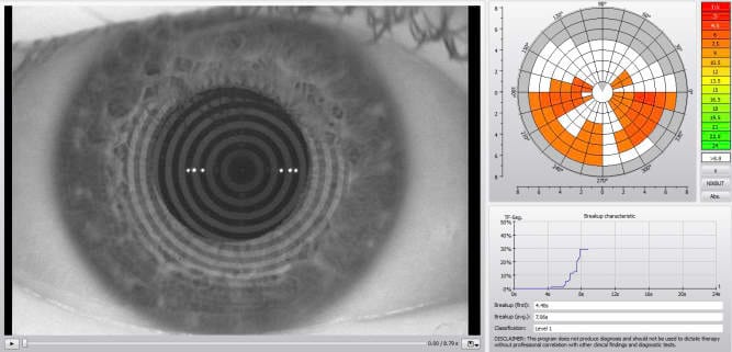 Fluorescein and tear film stability assessment