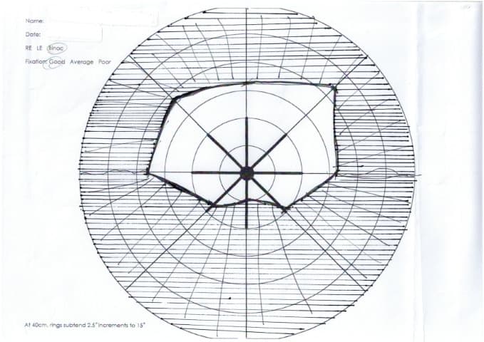 NAAION Fig 1