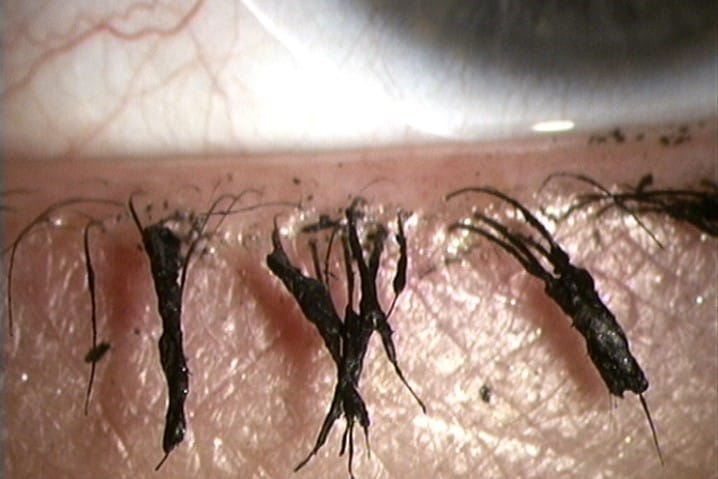 Dry eye and cosmetics: a clinical experience