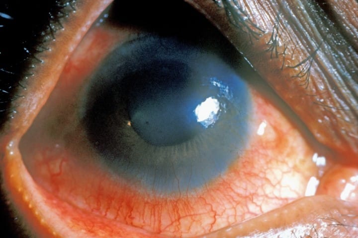 High recurrence rate for uveitis patients