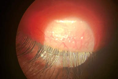 Fig 2 Collarettes And Debri On Eyelash Base (1)