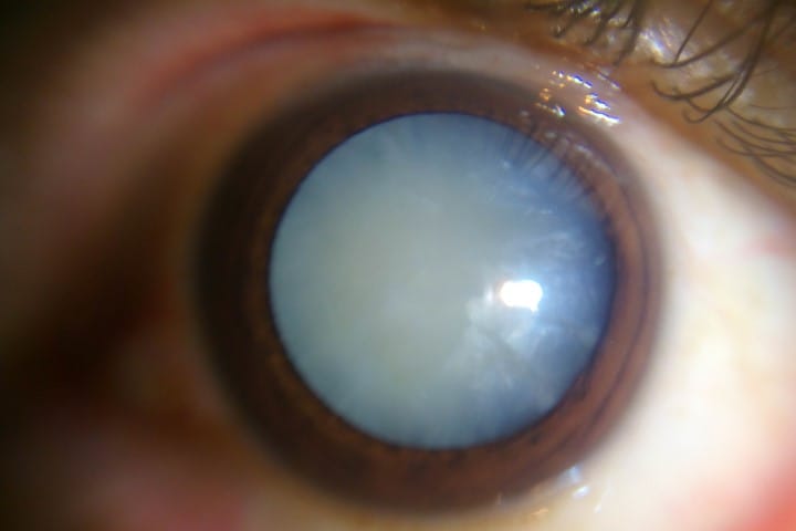 Novel cataract drop’s promising results