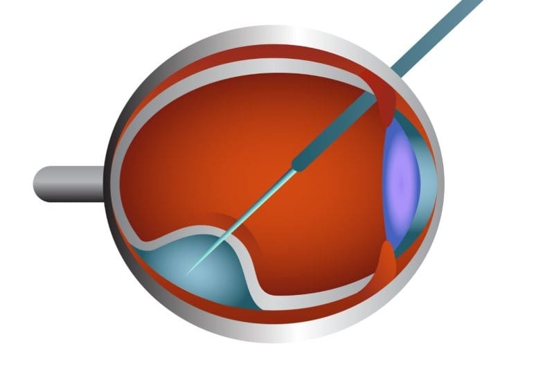subretinal injection online