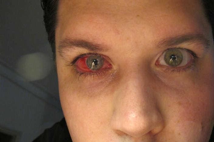 Keratoplasty rejection after Covid vaccination (1)