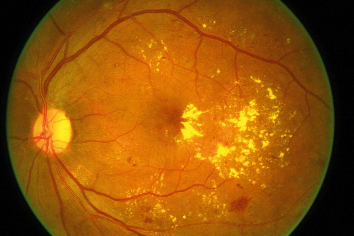 severe diabetic macular odaema