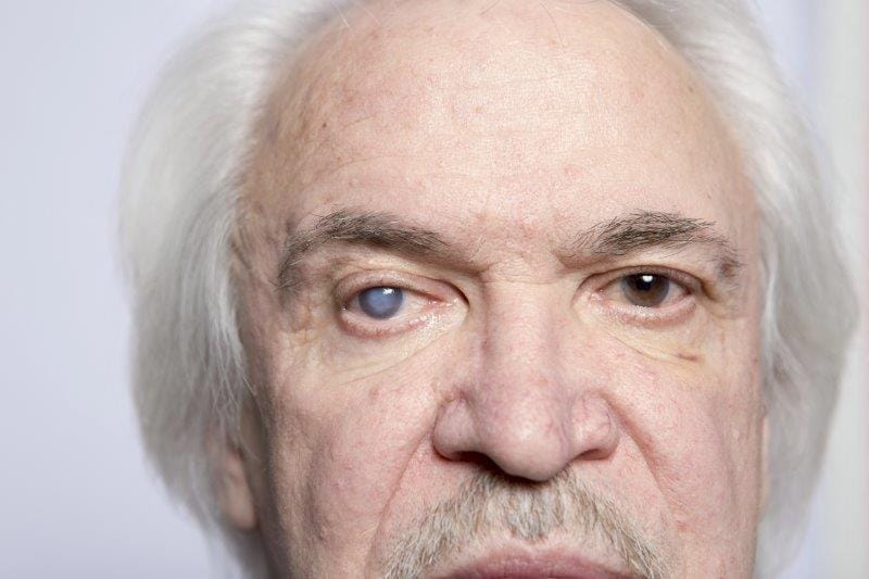 Cataract surgery and dementia (1)