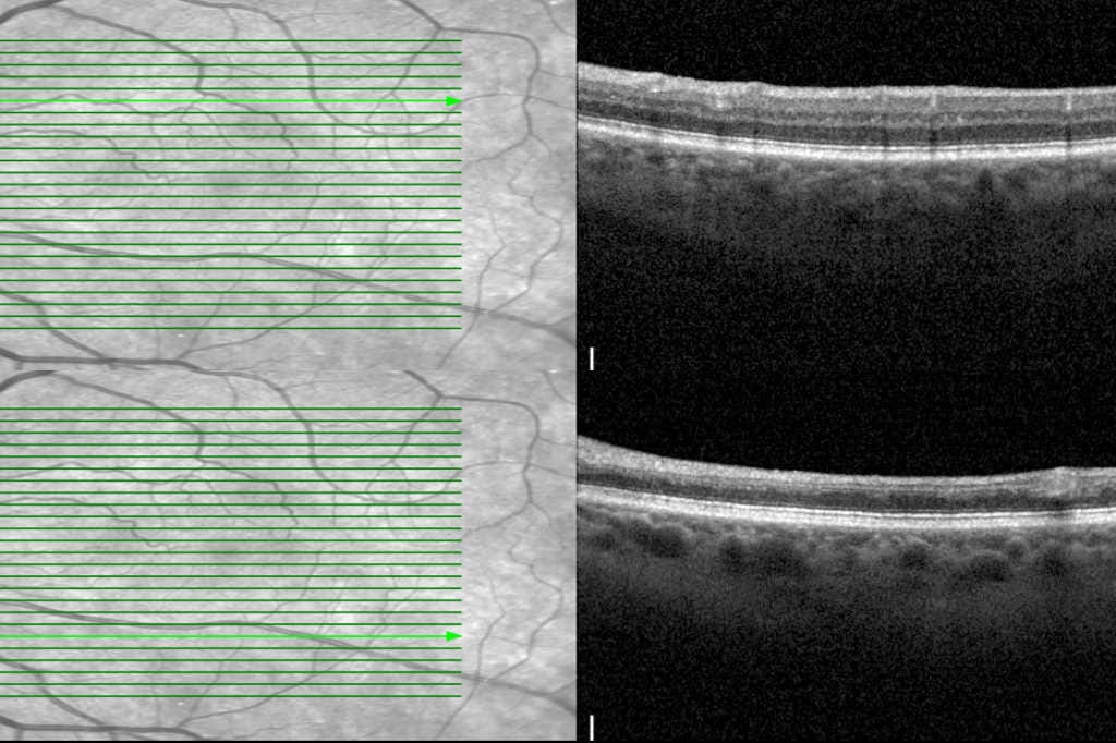 Ischaemic optic neuropathy or retinal artery occlusion?