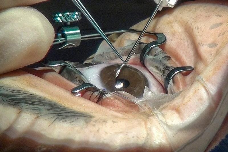 Interventional glaucoma: the future is now