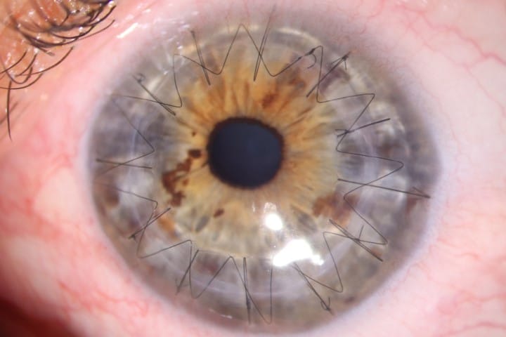 Trends in corneal transplantation: beyond 2020