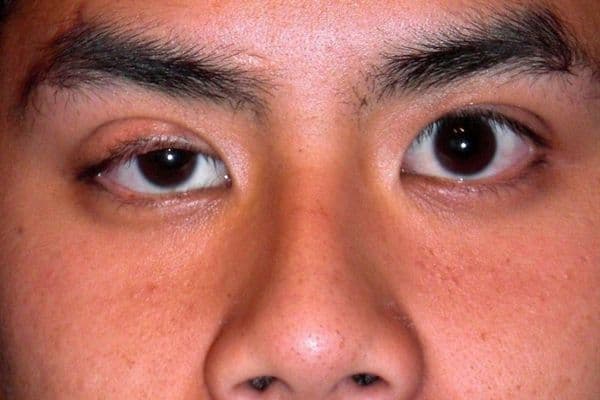 IRIS measuring ptosis with a single photograph