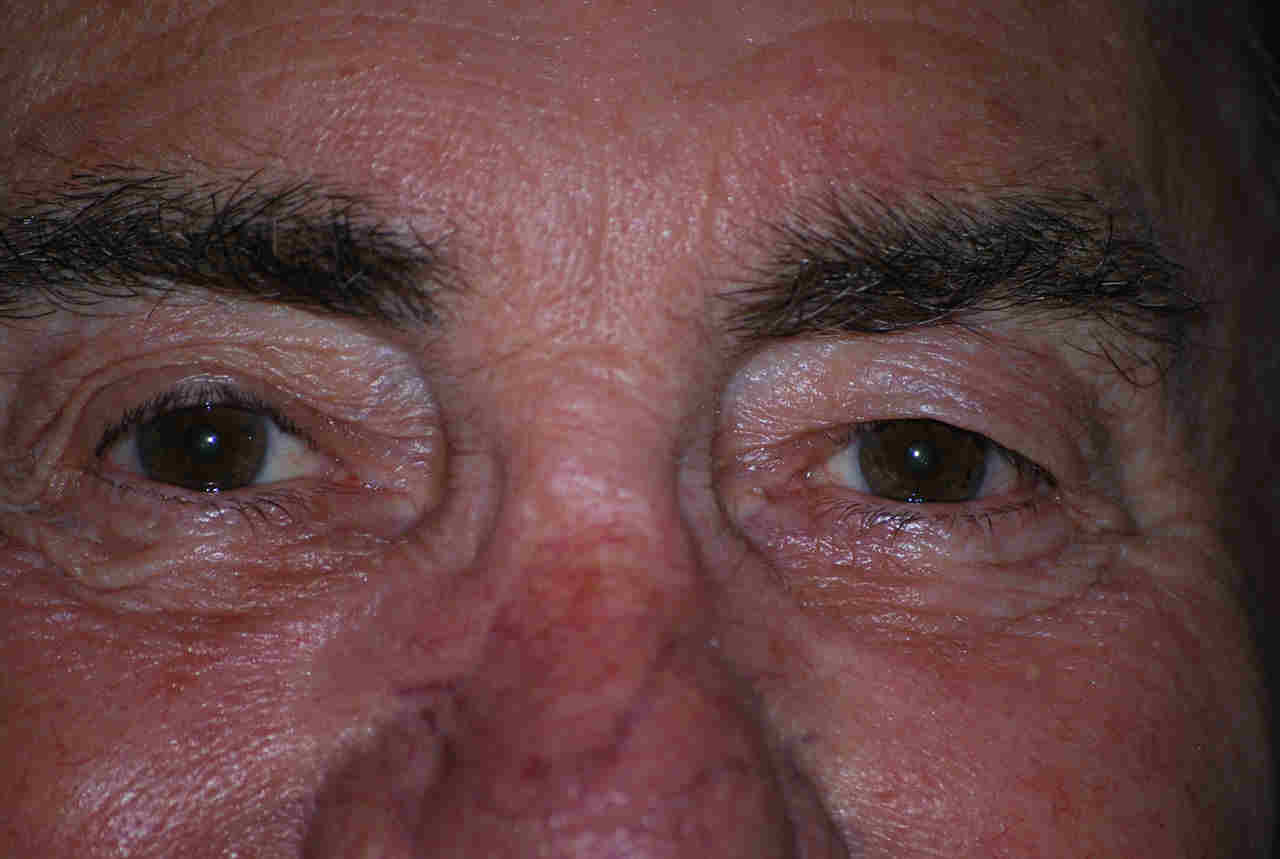 Krill vs fish oil and other eye treatments eyeonoptics
