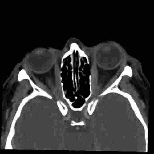 Thyroidassociated ophthalmopathy nzoptics