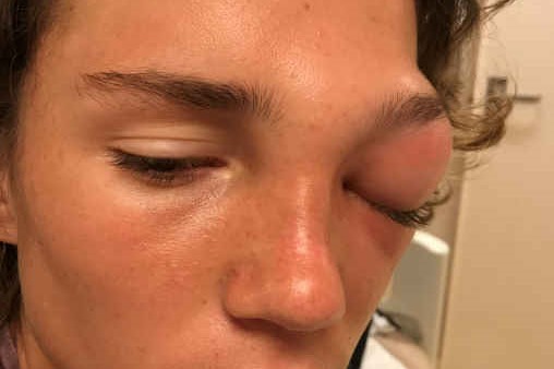 Management of cellulitis picture