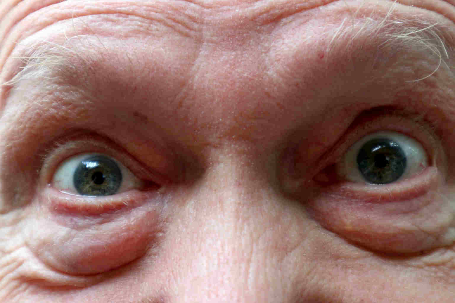 Dry AMD treatment trial fast tracked nzoptics